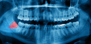 panoramic dental xray