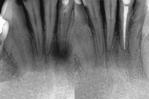 root canal